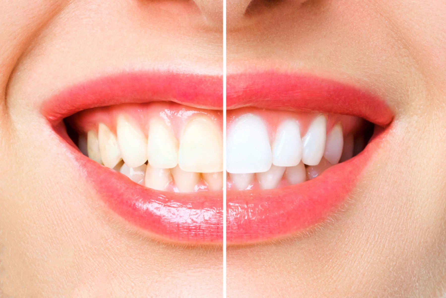 advantages-of-professional-teeth-whitening