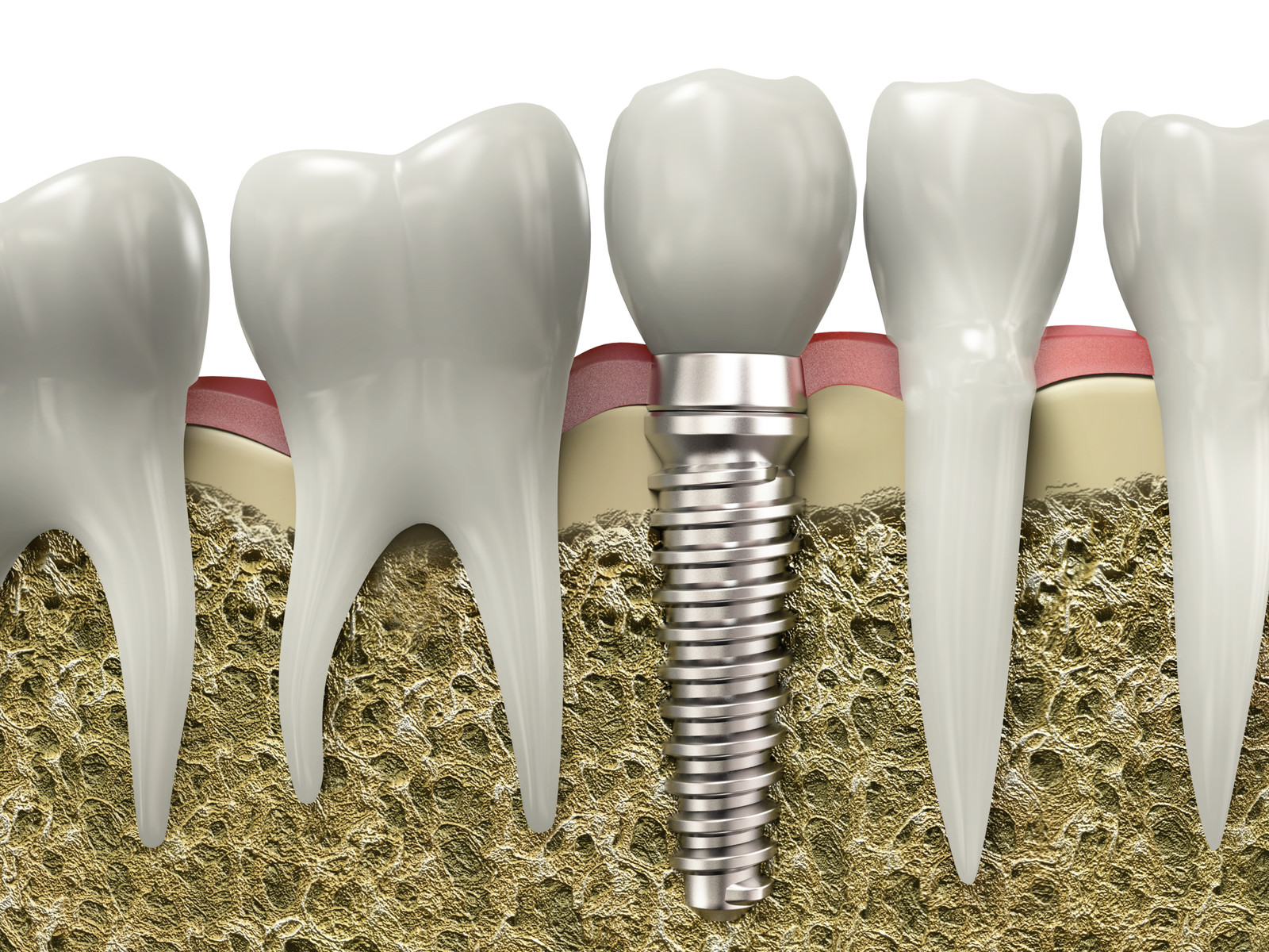 are dental implants the right option for you
