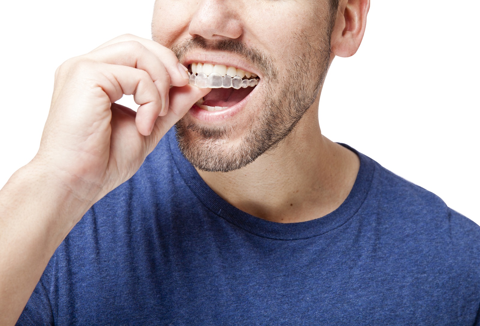 What Kinds Of Problems Can Invisalign Fix